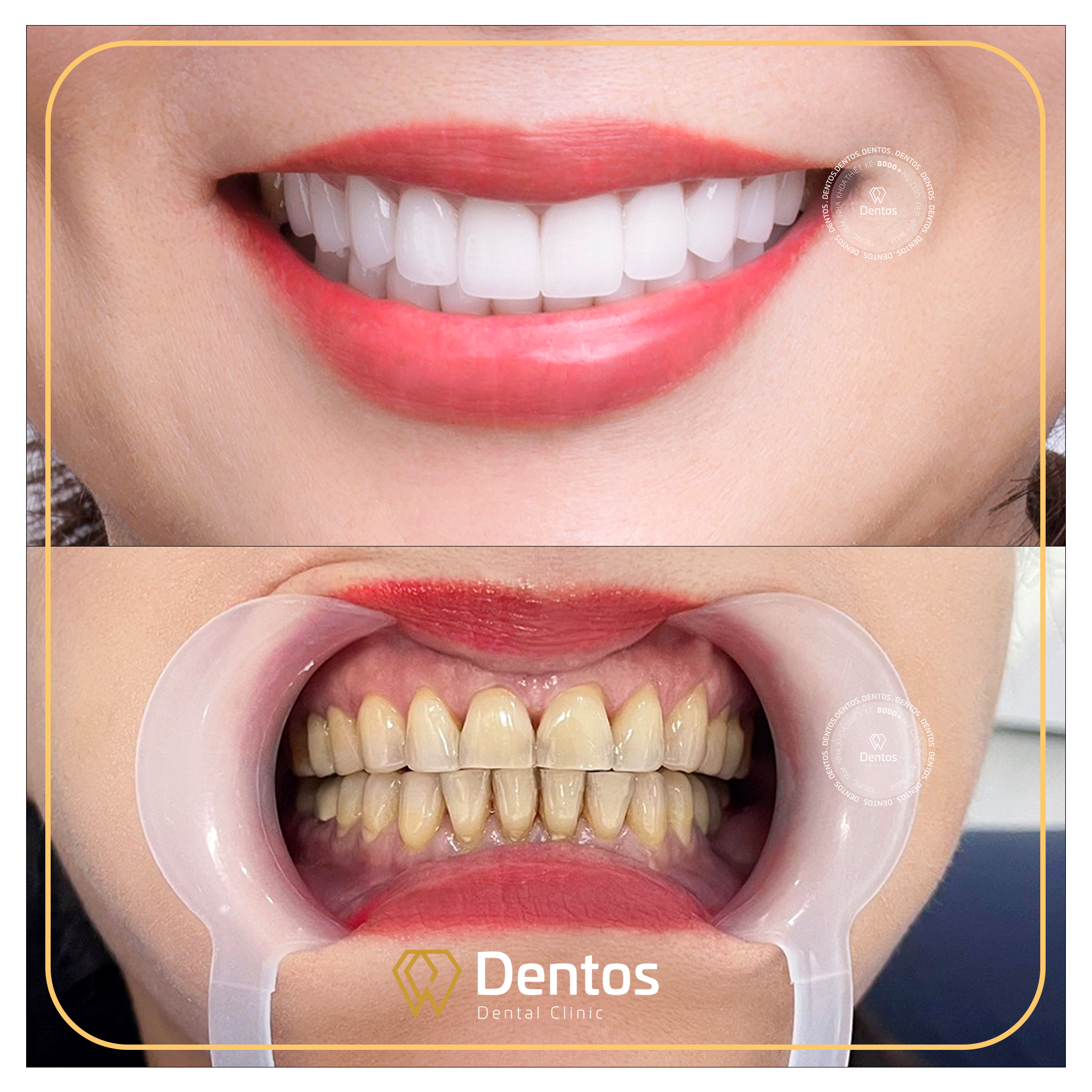 Bọc răng sứ thẩm mỹ giúp che phủ hoàn toàn tình trạng nhiễm màu tetracycline